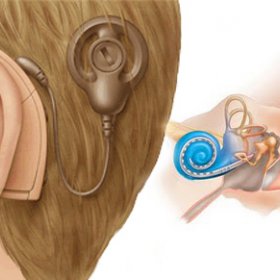 Justiça derruba decisão que obrigava SUS a fazer implante de aparelho nos dois ouvidos