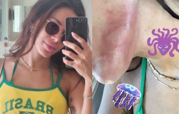 Anitta sofre queimadura de água-viva no rosto ao nadar em Ibiza: "Dor do fim da vida"