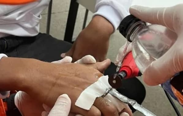 Bombeiros são acionados para retirar anel preso em dedo de adolescente na Bahia