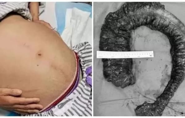 Médicos tiram fezes de 1 metro e 20 kg acumuladas no intestino de mulher