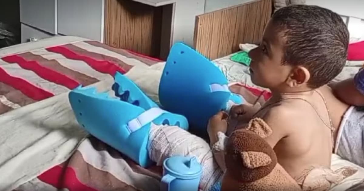 Criança de três anos, portadora da doença dos 'ossos de vidro' passou pela primeira cirurgia reparadora do SUS na Bahia