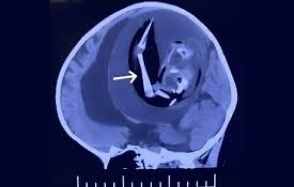 Médicos encontram feto “parasita” dentro do crânio de bebê de 1 ano