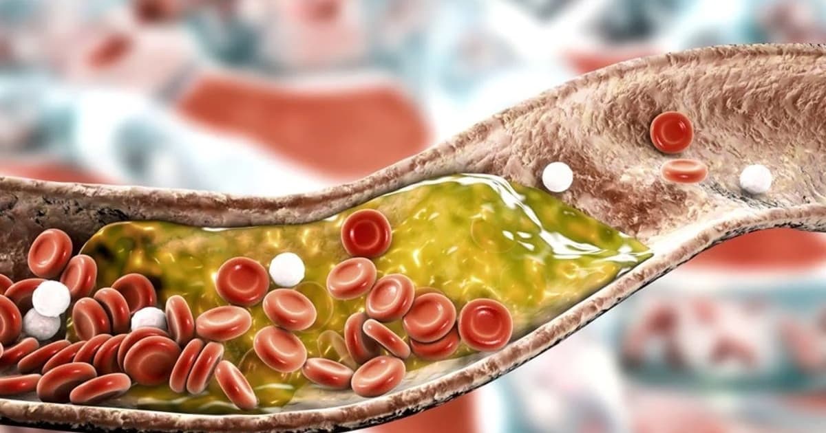 Anvisa aprova remédio para colesterol injetado apenas 2 vezes por ano