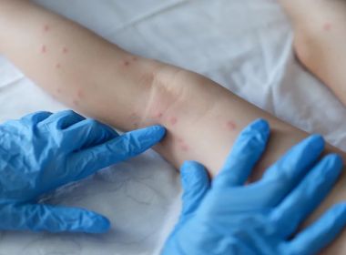 Salvador confirma mais 2 casos de 'varíola dos macacos'